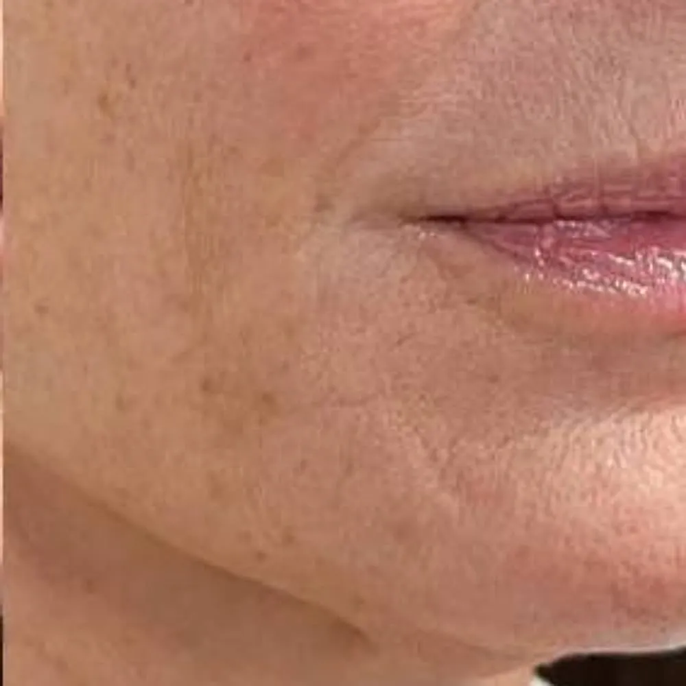 After: Facial contour and skin quality