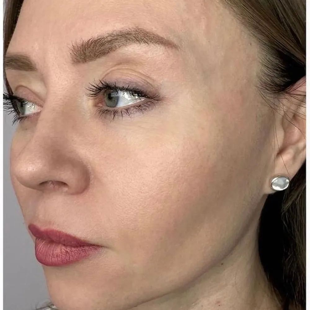 After: Redness and uneven tone