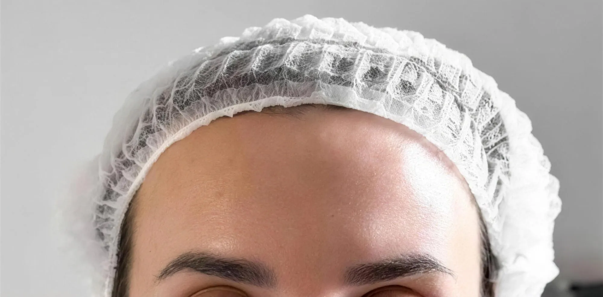 After: Forehead lines