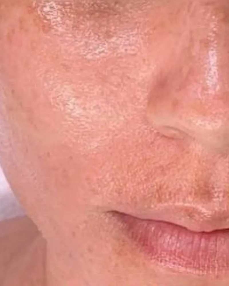 After: Pigmentation and tone