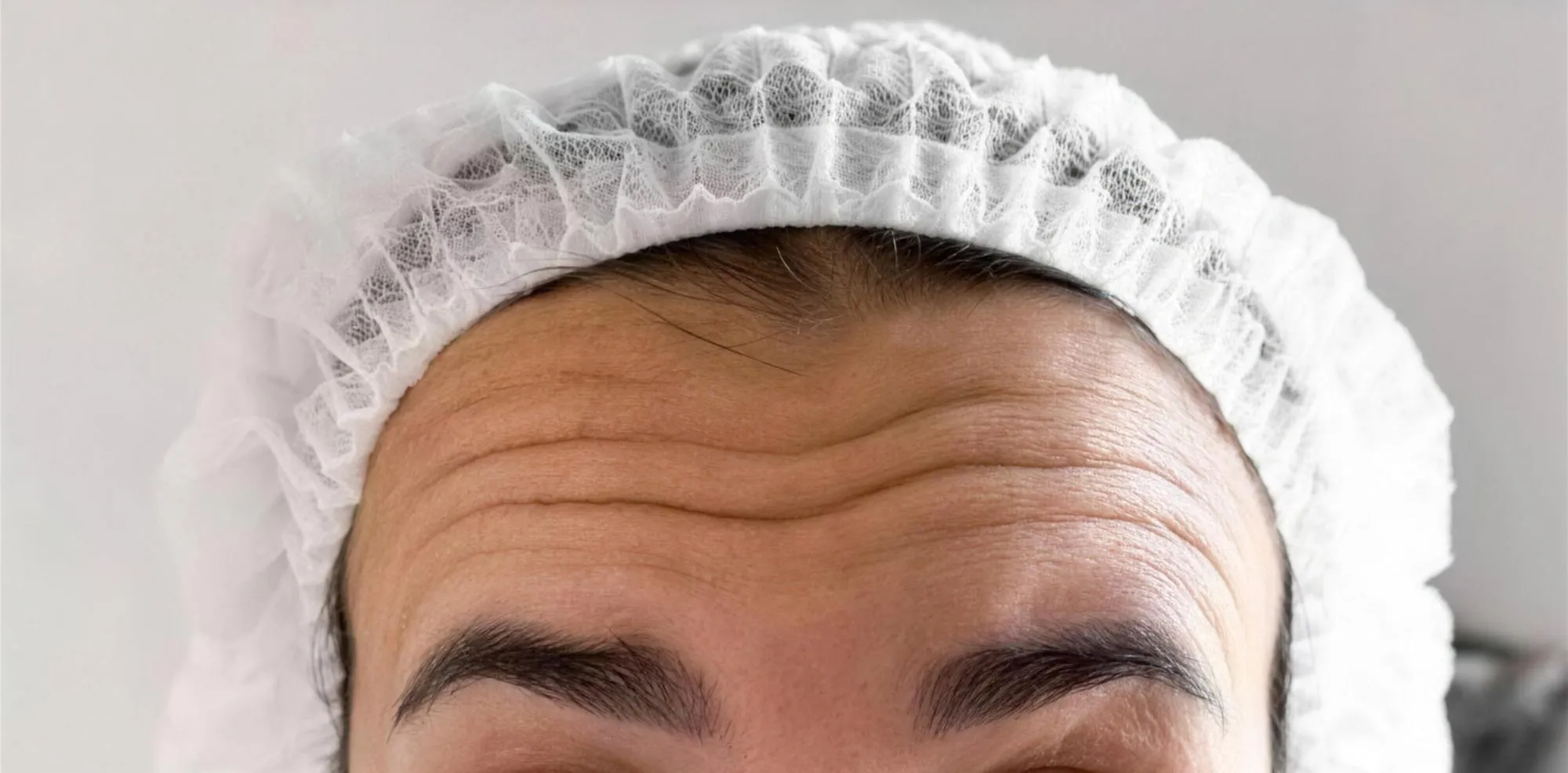 Before: Forehead lines