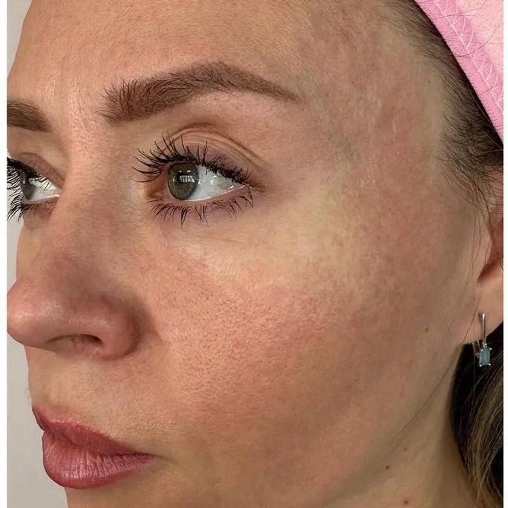 Before: Redness and uneven tone