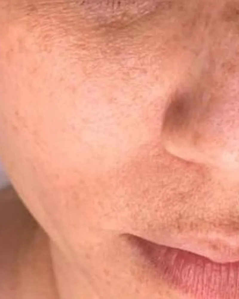 Before: Pigmentation and tone