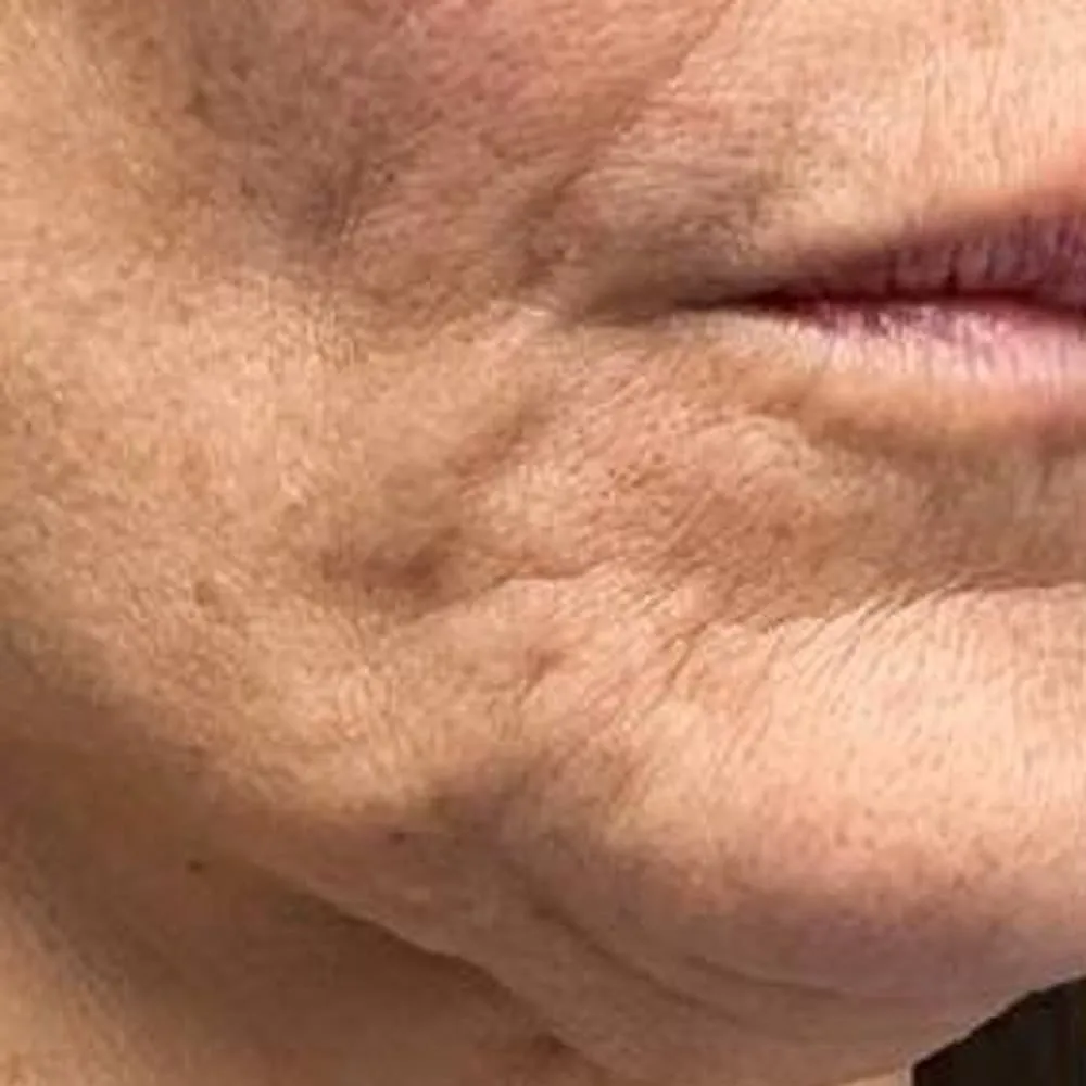 Before: Facial contour and skin quality