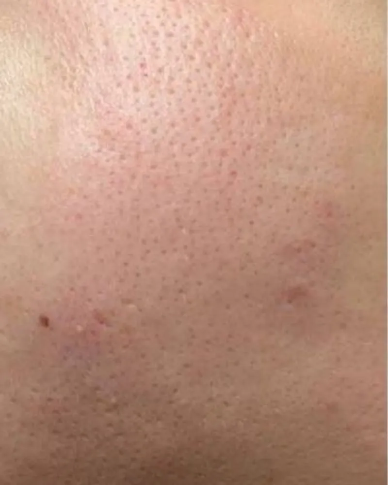 Before: Texture and pores