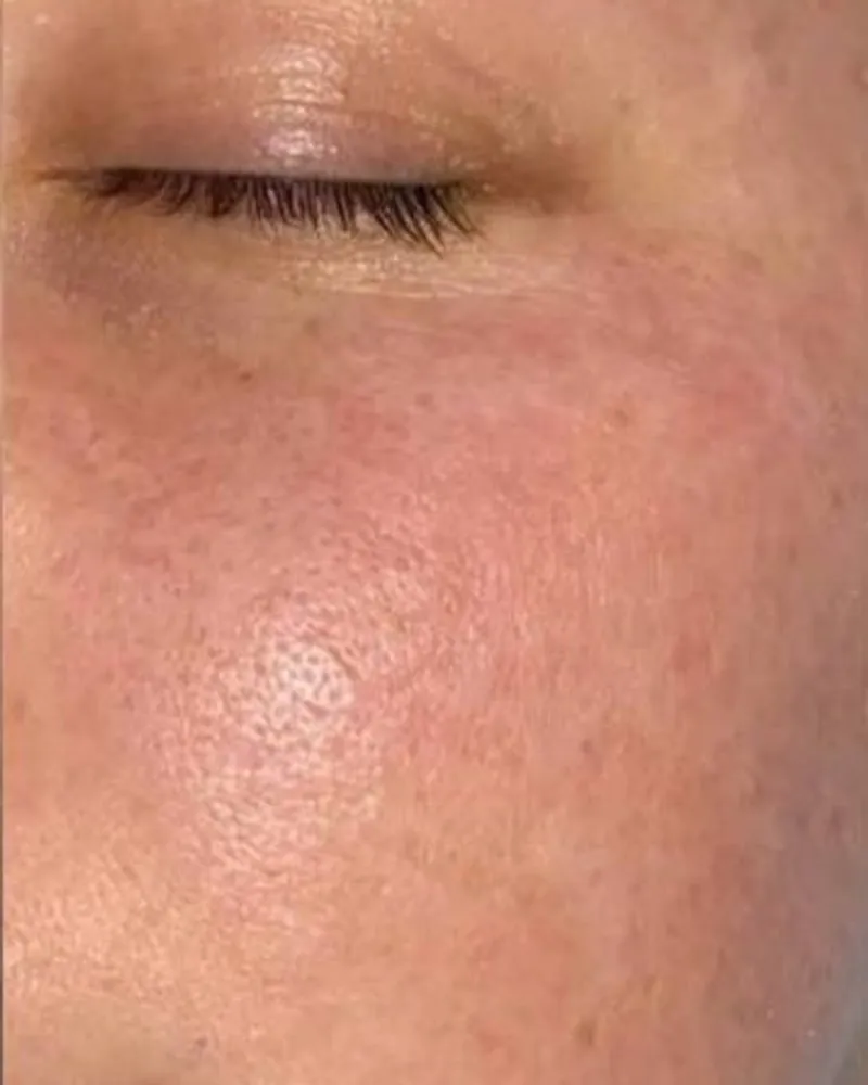 After: Dullness and uneven tone