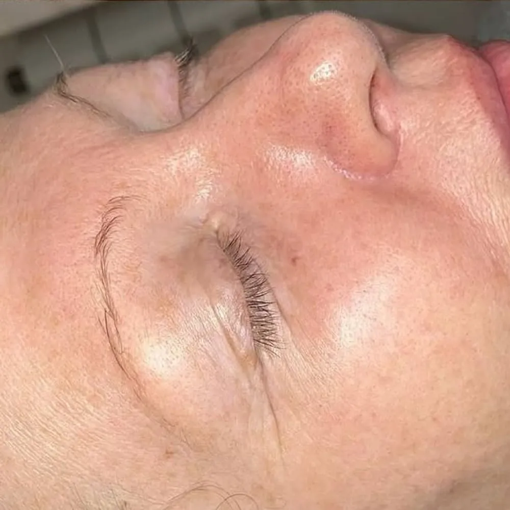 After: Pigmentation and freckles