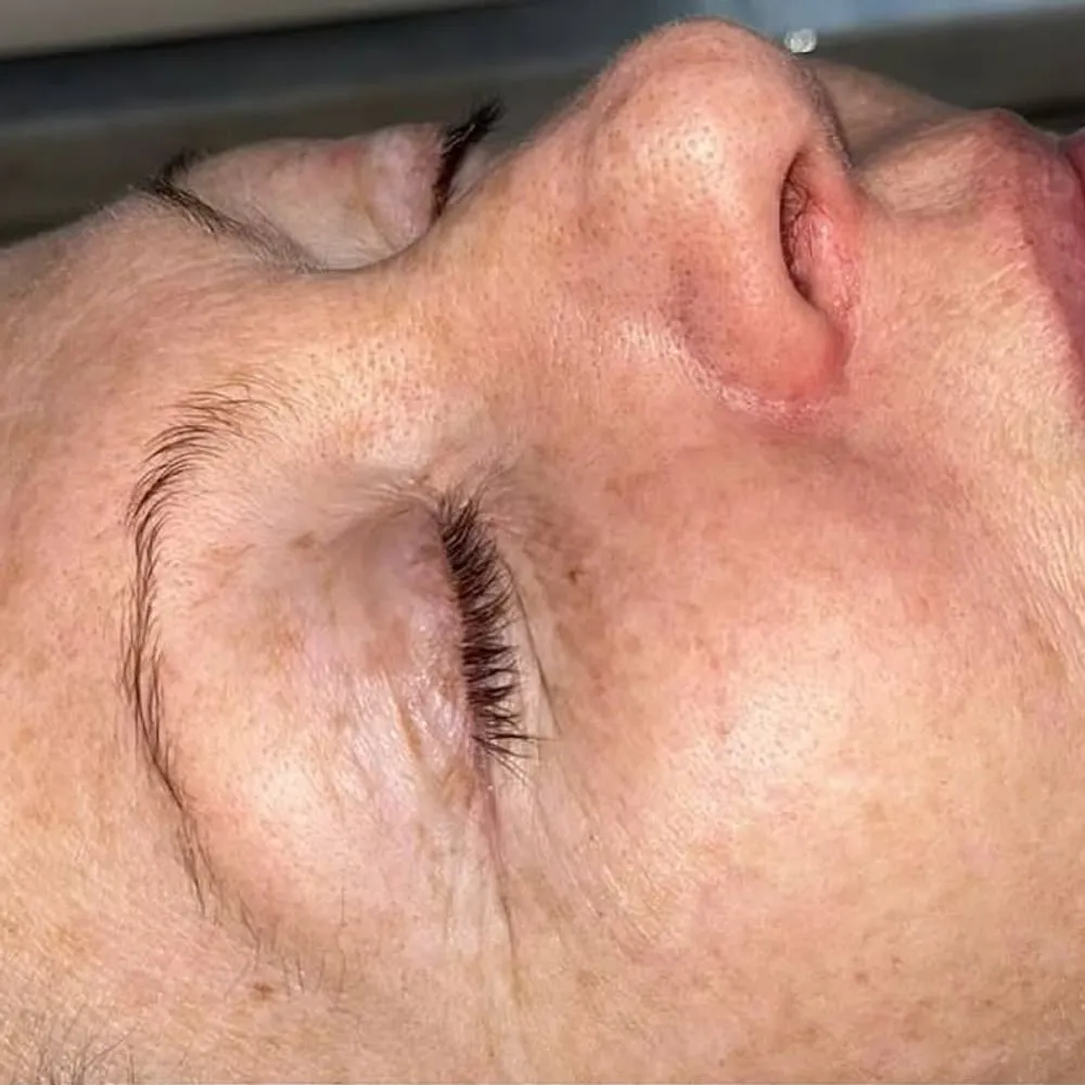 Before: Pigmentation and freckles