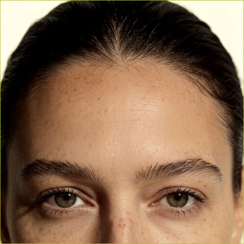 Close-up of the forehead—an area treated with botulinum therapy